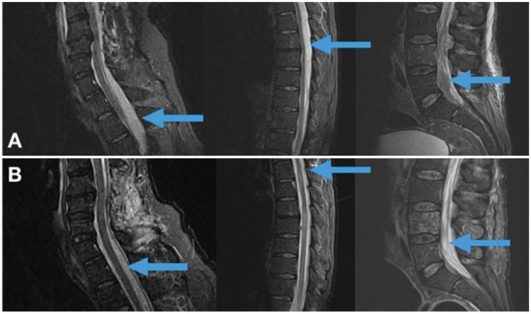 Imagen Cervical Thoracic Lumbosacral MRI
