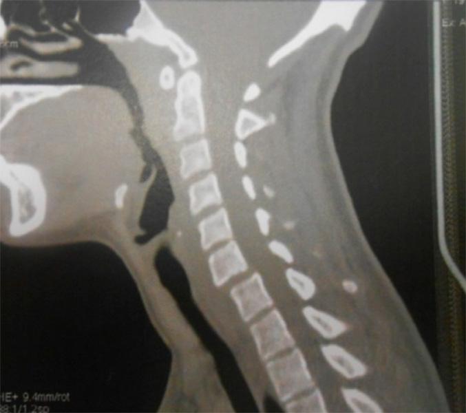 Imagen Espondilolisis Cervical