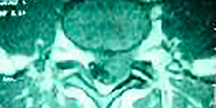 Imagen Hernia de Disco Lumbar