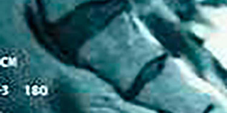 Imagen Lumbociatalgia