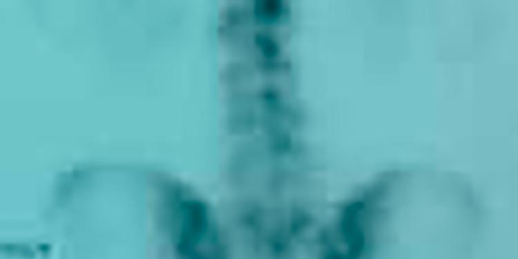 Imagen Osteoma Osteoide