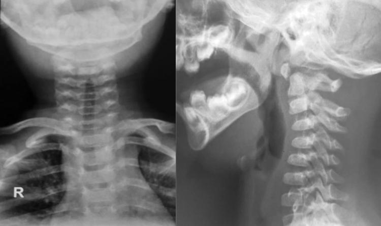 Imagen Espondilolisis cervical de C2