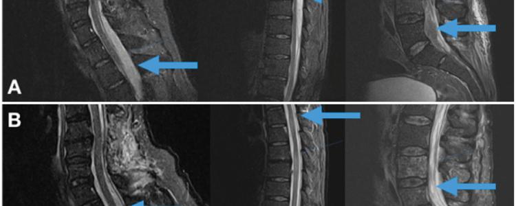 Imagen Cervical Thoracic Lumbosacral MRI