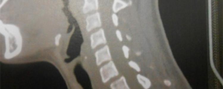 Imagen Espondilolisis Cervical