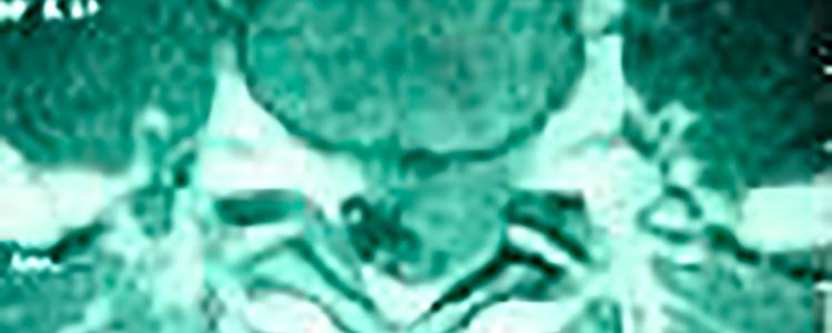 Imagen Hernia de Disco Lumbar
