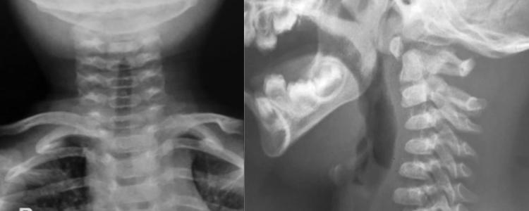 Imagen Espondilolisis cervical de C2